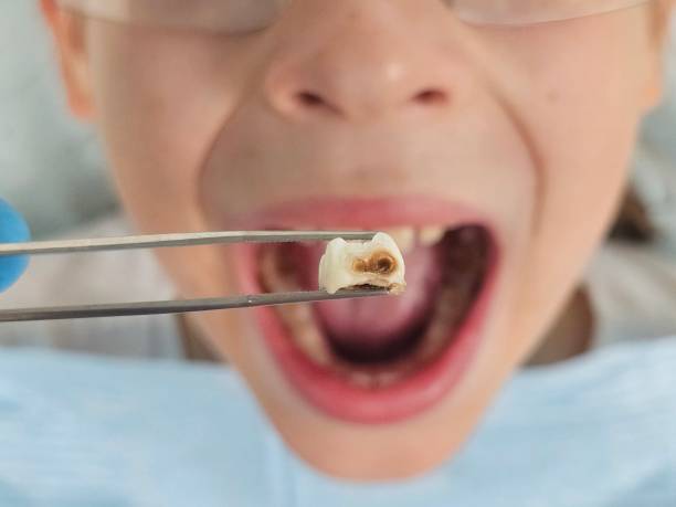 Best Emergency Wisdom Tooth Extraction in Miami Beach, FL